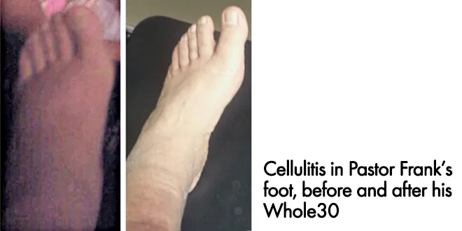 cellulitis
